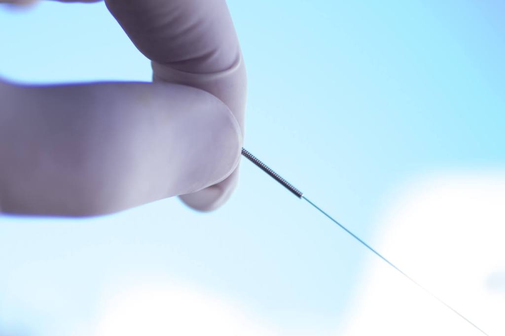 What is Dry Needling and How Can It Benefit&nbsp;Me?